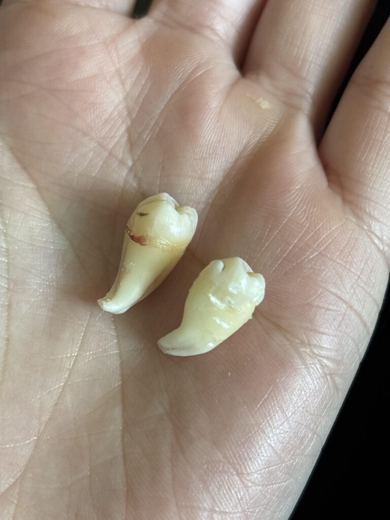 Two small tooth fragments held in the palm, light-colored with slight red-brown marks at the base.